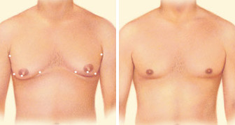 male breast reduction male breast reduction