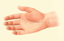 Carpal Tunnel Relief Carpal Tunnel Relief
