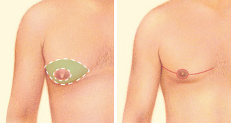 male breast reduction male breast reduction