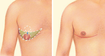 male breast reduction male breast reduction
