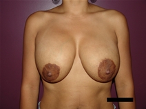 Breast Lift Before Photo by Moneer Jaibaji, MD; ,  - Case 21465