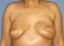 Breast Reconstruction After Photo by Neal Goldberg, MD; Scarsdale, NY - Case 22556