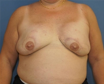 Breast Reconstruction After Photo by Neal Goldberg, MD; Scarsdale, NY - Case 23150