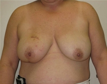 Breast Reconstruction Before Photo by Neal Goldberg, MD; Scarsdale, NY - Case 23150