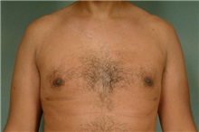Male Breast Reduction After Photo by Robert Zubowski, MD; ,  - Case 23736