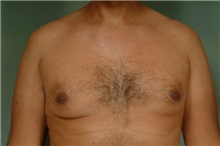 Male Breast Reduction Before Photo by Robert Zubowski, MD; ,  - Case 23736