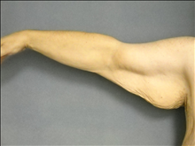 Arm Lift Before Photo by Ellen Janetzke, MD; ,  - Case 25137