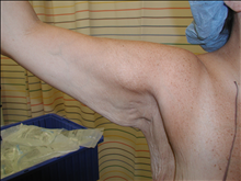 Arm Lift Before Photo by David Abramson, MD; Englewood, NJ - Case 25181