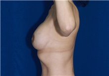 Breast Lift After Photo by Ricardo Rodriguez, MD; Lutherville-Timonium, MD - Case 27080