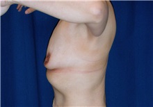 Breast Lift Before Photo by Ricardo Rodriguez, MD; Lutherville-Timonium, MD - Case 27080