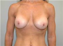 Breast Lift After Photo by Elisa Burgess, MD; ,  - Case 27307