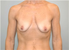 Breast Lift Before Photo by Elisa Burgess, MD; ,  - Case 27307