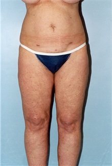 Liposuction After Photo by Kristoffer Ning Chang, MD; ,  - Case 28247