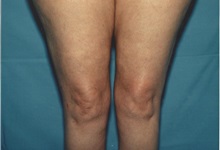 Liposuction After Photo by Kristoffer Ning Chang, MD; ,  - Case 28335