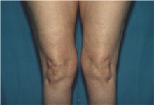 Liposuction Before Photo by Kristoffer Ning Chang, MD; ,  - Case 28335