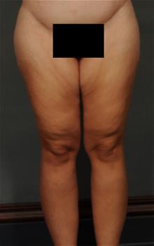 Thigh Lift Before Photo by Ellen Janetzke, MD; ,  - Case 29770