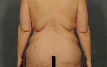 Body Lift Before Photo by Ellen Janetzke, MD; ,  - Case 29803