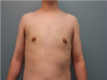 Male Breast Reduction After Photo by Larry Nichter, MD; ,  - Case 29831