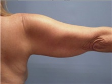 Arm Lift Before Photo by Larry Nichter, MD; ,  - Case 29854