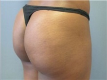 Buttock Lift with Augmentation After Photo by Larry Nichter, MD; ,  - Case 29855