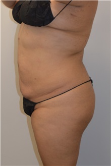 Buttock Lift with Augmentation Before Photo by Meegan Gruber, MD, PhD; Tampa, FL - Case 29921