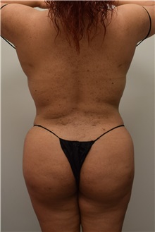 Buttock Lift with Augmentation After Photo by Meegan Gruber, MD, PhD; Tampa, FL - Case 29921