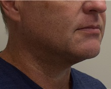 Liposuction After Photo by Meegan Gruber, MD, PhD; Tampa, FL - Case 29924