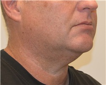 Liposuction Before Photo by Meegan Gruber, MD, PhD; Tampa, FL - Case 29924
