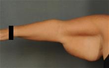 Arm Lift Before Photo by Ellen Janetzke, MD; ,  - Case 29963