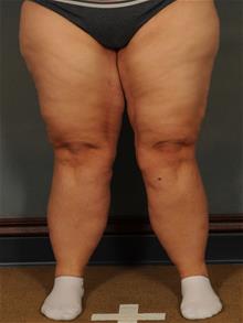 Thigh Lift After Photo by Ellen Janetzke, MD; ,  - Case 29966