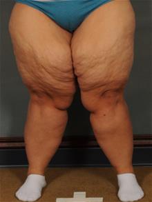 Thigh Lift Before Photo by Ellen Janetzke, MD; ,  - Case 29966
