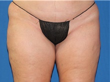 Liposuction After Photo by Timothy Mountcastle, MD; ashburn, VA - Case 29993