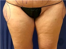 Liposuction Before Photo by Timothy Mountcastle, MD; ashburn, VA - Case 29993