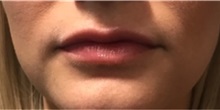 Dermal Fillers After Photo by Timothy Mountcastle, MD; ashburn, VA - Case 30006