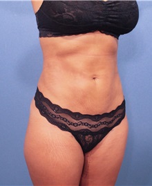 Liposuction After Photo by Marvin Shienbaum, MD; Brandon, FL - Case 30074