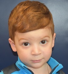 Craniosynostosis After Photo by Rachel Ruotolo, MD; Garden City, NY - Case 30309