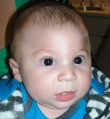 Craniosynostosis Before Photo by Rachel Ruotolo, MD; Garden City, NY - Case 30309