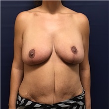 Breast Lift After Photo by Brian Pinsky, MD, FACS; Babylon, NY - Case 30433