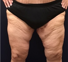Thigh Lift After Photo by Brian Pinsky, MD, FACS; Babylon, NY - Case 30435