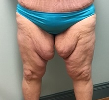 Thigh Lift Before Photo by Brian Pinsky, MD, FACS; Babylon, NY - Case 30435