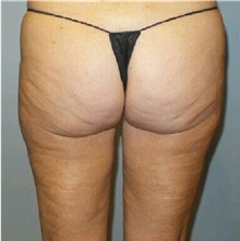 Body Contouring After Photo by Timothy Mountcastle, MD; ashburn, VA - Case 30538