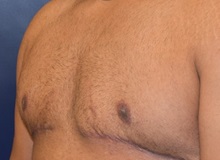 Male Breast Reduction After Photo by Richard Reish, MD, FACS; New York, NY - Case 30554