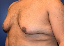 Male Breast Reduction Before Photo by Richard Reish, MD, FACS; New York, NY - Case 30554
