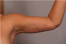 Arm Lift After Photo by Kent Hasen, MD; Naples, FL - Case 30693