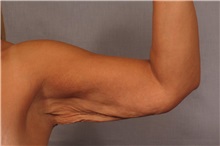 Arm Lift Before Photo by Kent Hasen, MD; Naples, FL - Case 30693