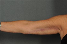 Arm Lift After Photo by Ellen Janetzke, MD; ,  - Case 30788