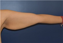 Arm Lift Before Photo by Richard Reish, MD, FACS; New York, NY - Case 30791