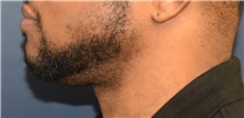 Chin Augmentation After Photo by Richard Reish, MD, FACS; New York, NY - Case 30828