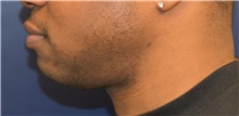 Chin Augmentation Before Photo by Richard Reish, MD, FACS; New York, NY - Case 30828