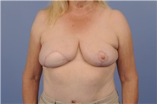 Breast Reconstruction After Photo by Trent Douglas, MD; Knoxville, TN - Case 31408